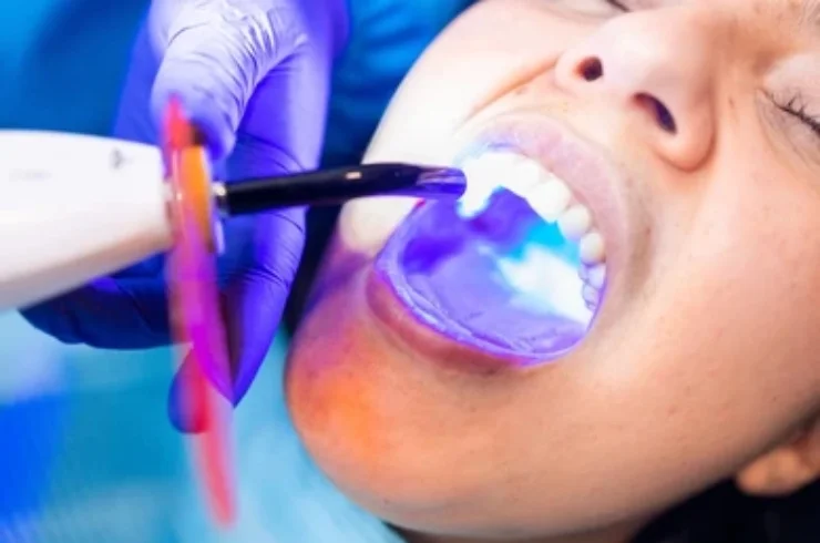 Dental Fillings-