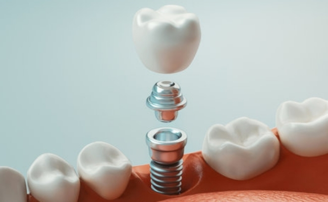 Dental-implants-32