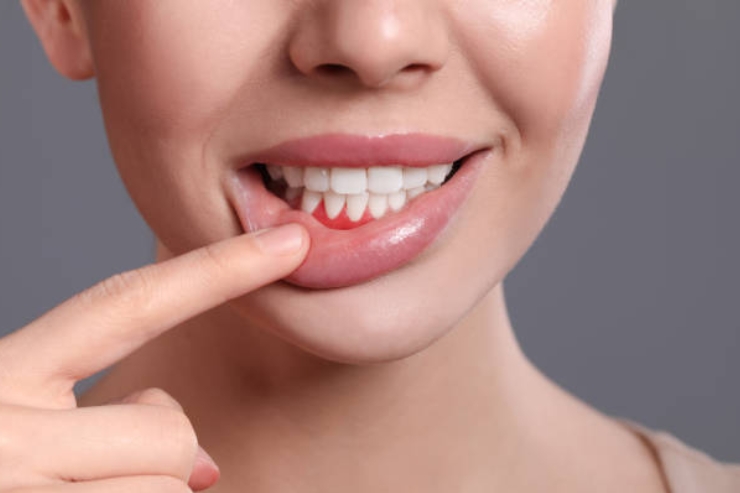 Gum Disease Treatment