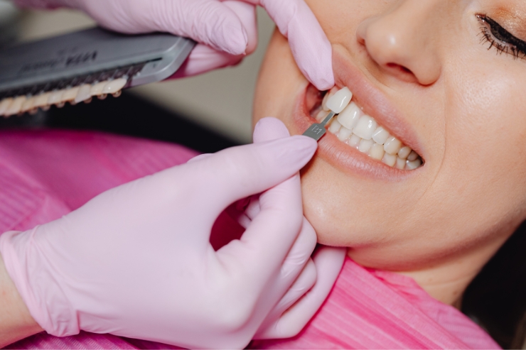 Veneers