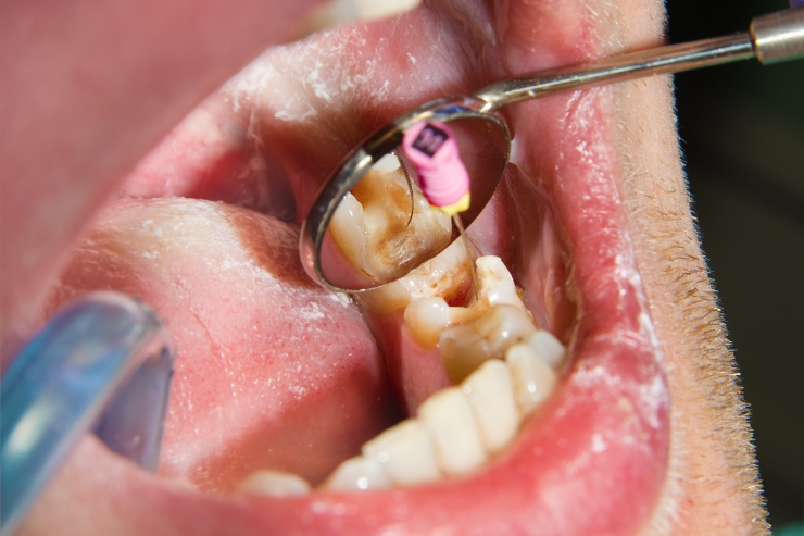 Root Canal Treatment------33